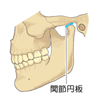 顎関節症図